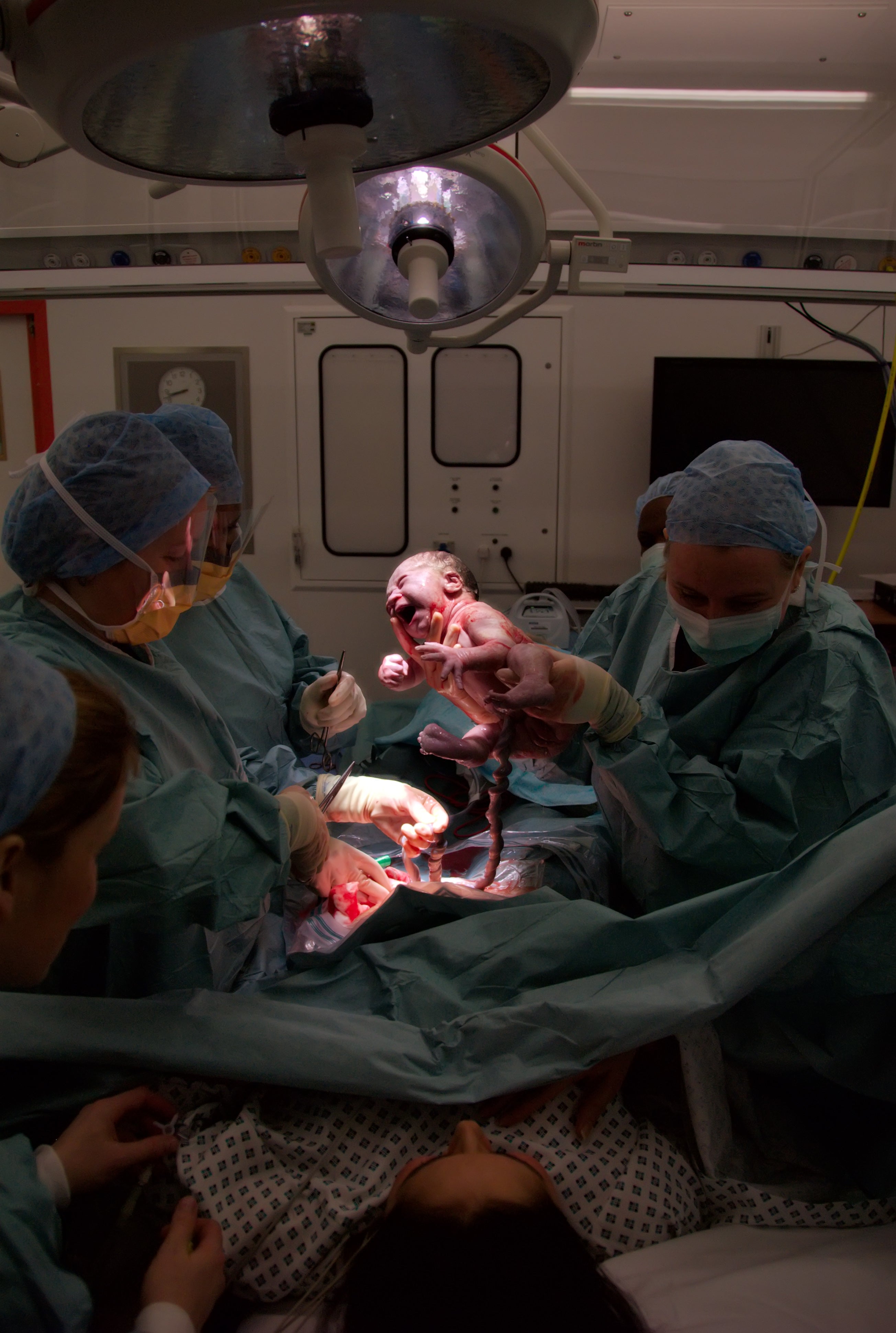C Section Delivery